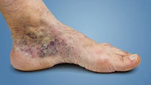Venous Stasis Ulcer Care